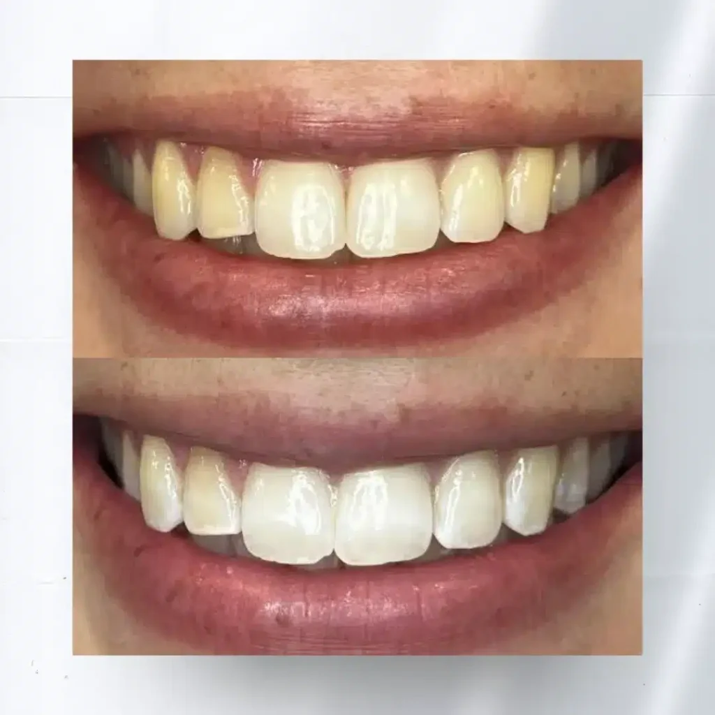 Boujee Smile Results